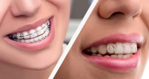 Ortodoncia tradicional y ortodoncia invisible
